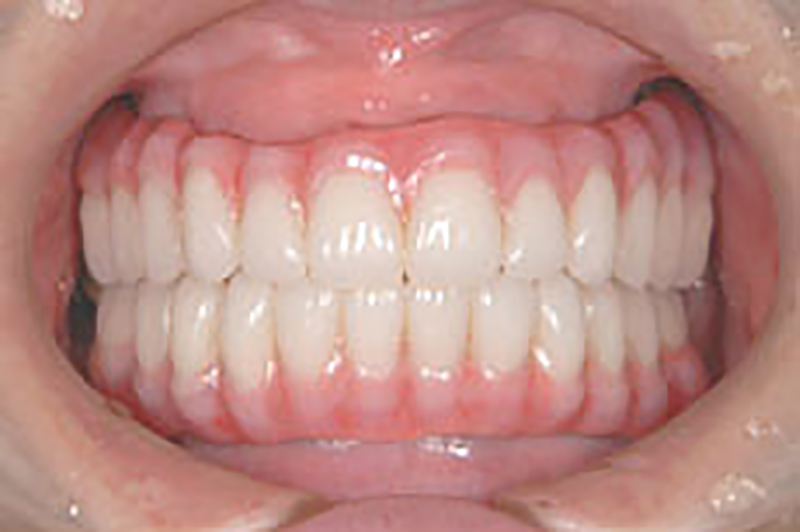 宇部市歯科医院のあいおい歯科・インプラント矯正クリニックのホワイトニングと白い歯を保つために